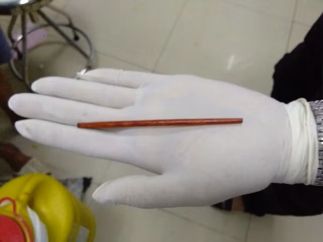Sau cơn nhậu say, người đàn ông phát hiện chiếc đũa dài 12 cm nằm trong dương vật ảnh 1
