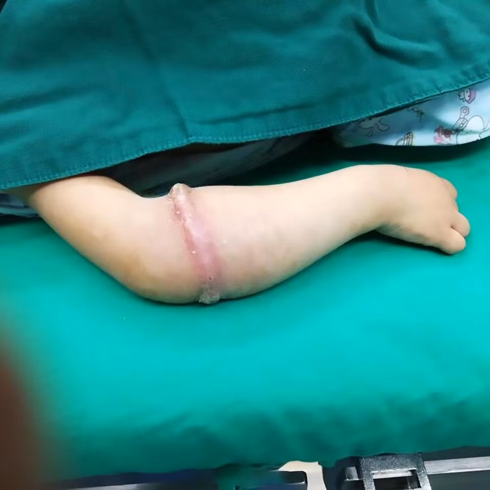 Dây chun đeo quá lâu ăn sâu vào thịt bé gái ảnh 1