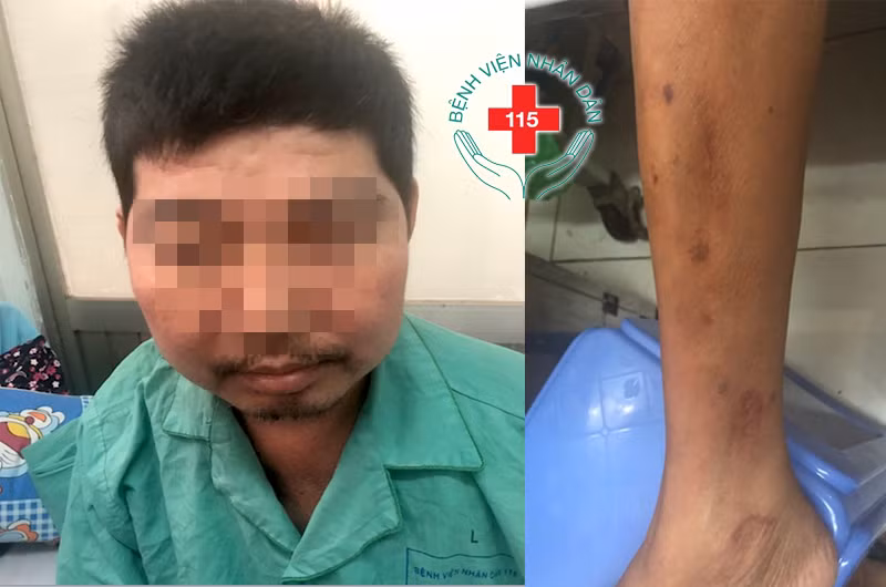 Sưng mặt, teo tay chân vì dùng thuốc đông y không rõ thành phần ảnh 1