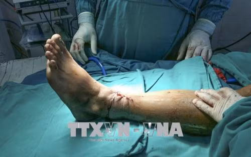 Bệnh viện Đa khoa tỉnh Điện Biên lần đầu tiên nối thành công phần chân đứt rời ảnh 1