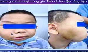 Phẫu thuật thành công ca u xơ vòm họng hiếm gặp ở bệnh nhi