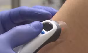 Công nghệ tia laser tiêm vaccine không đau đớn