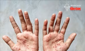 Bệnh đậu mùa khỉ liệu có lây lan mạnh?