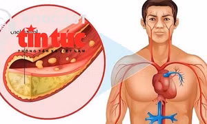 "Bác sĩ ơi' - Kiểm soát Cholesterol máu thế nào là đúng?