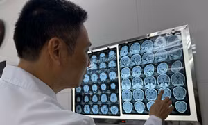 Gia tăng người bệnh bị sán làm tổ trong não