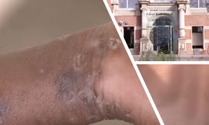 Đức đối mặt rủi ro sức khỏe cộng đồng như thế nào sau khi phát hiện ca mpox biến thể mới đầu tiên